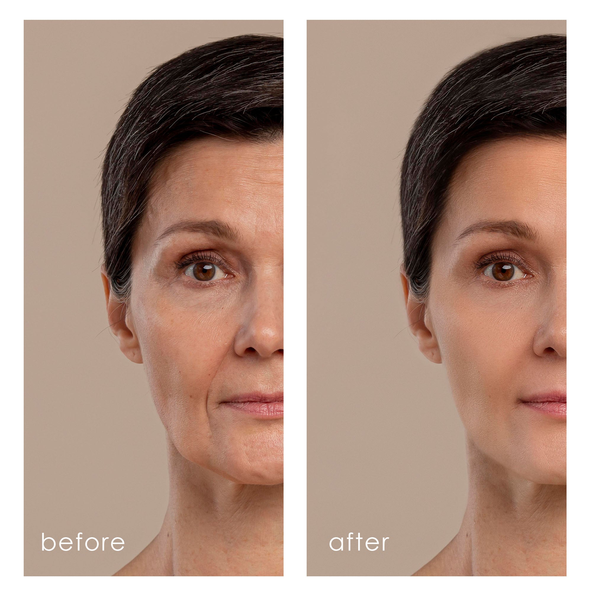 Needle-Free Mesotherapy Device