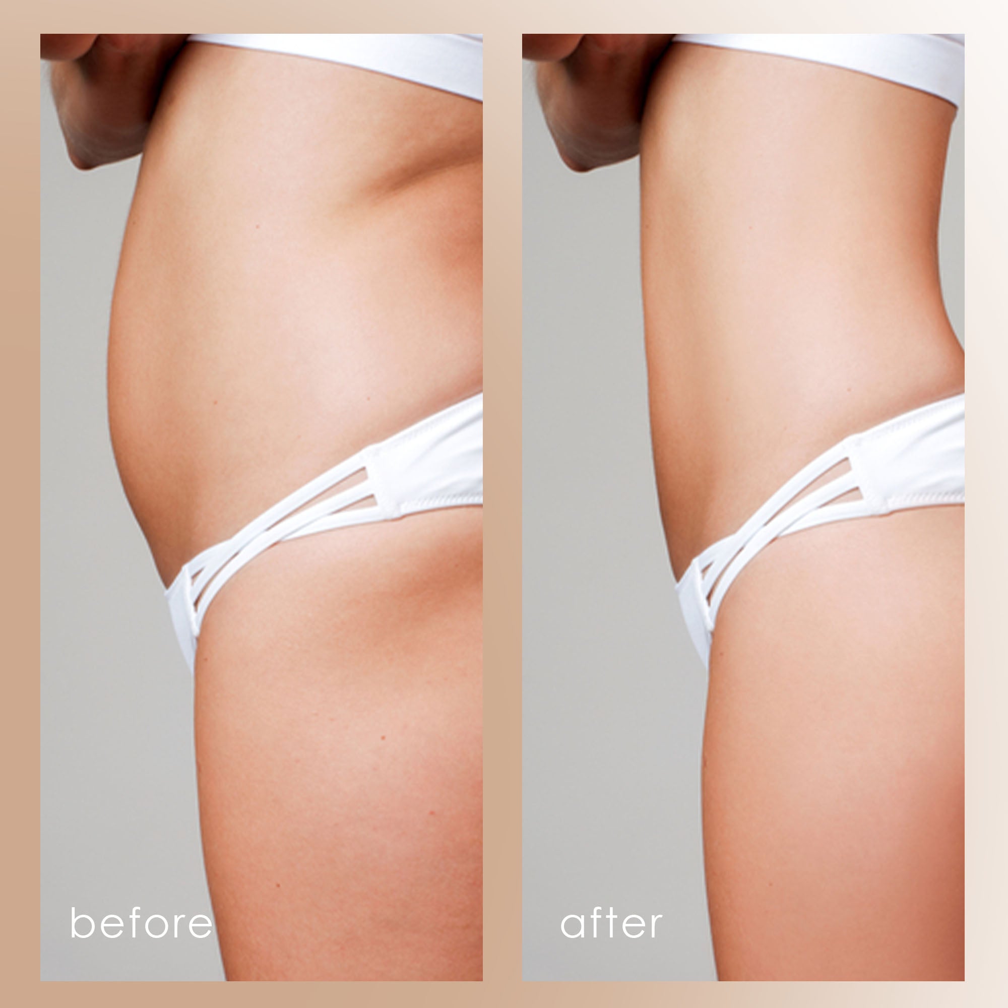 BodySculpt | LED RF Beauty System