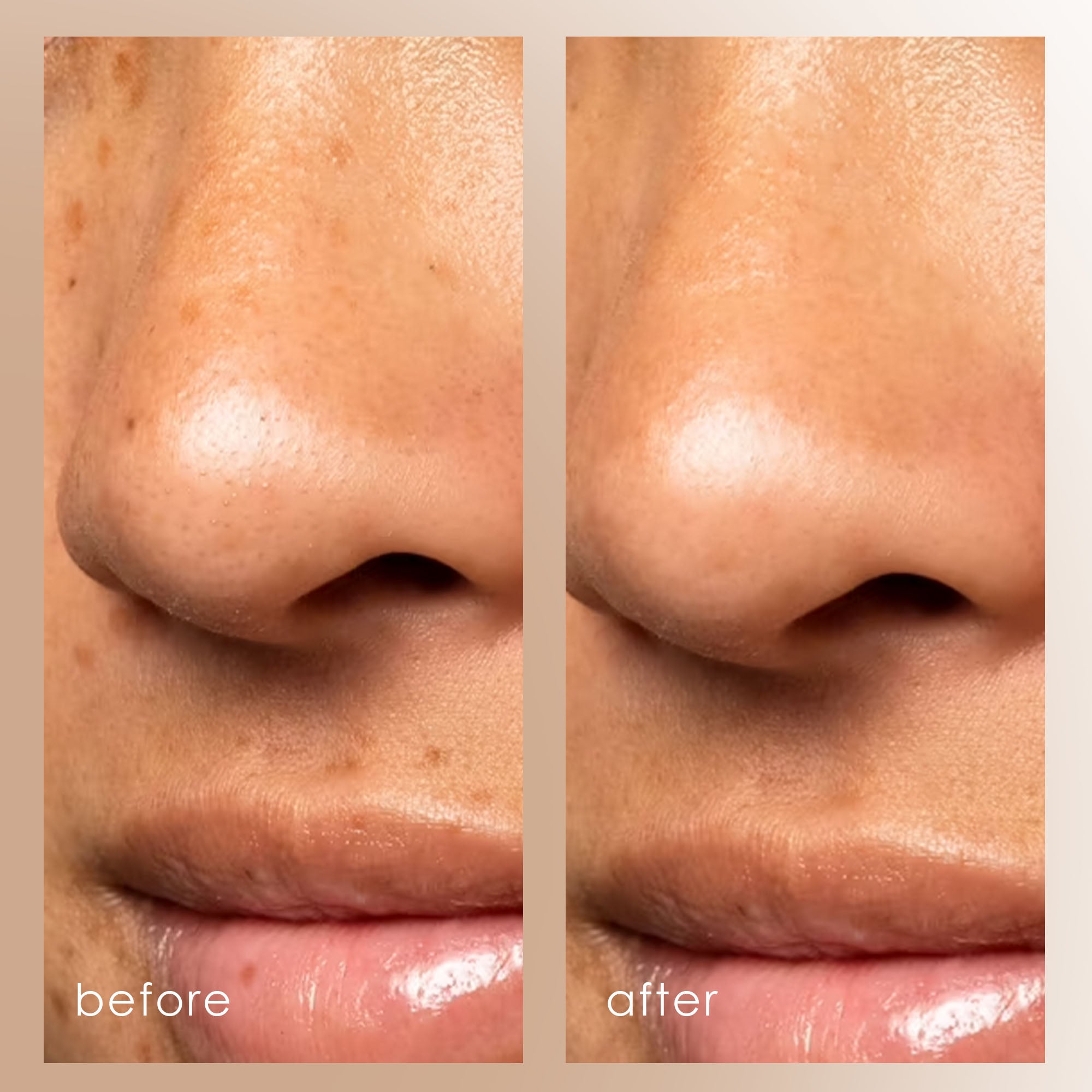 Vacuum+ Blackhead Removal Therapy