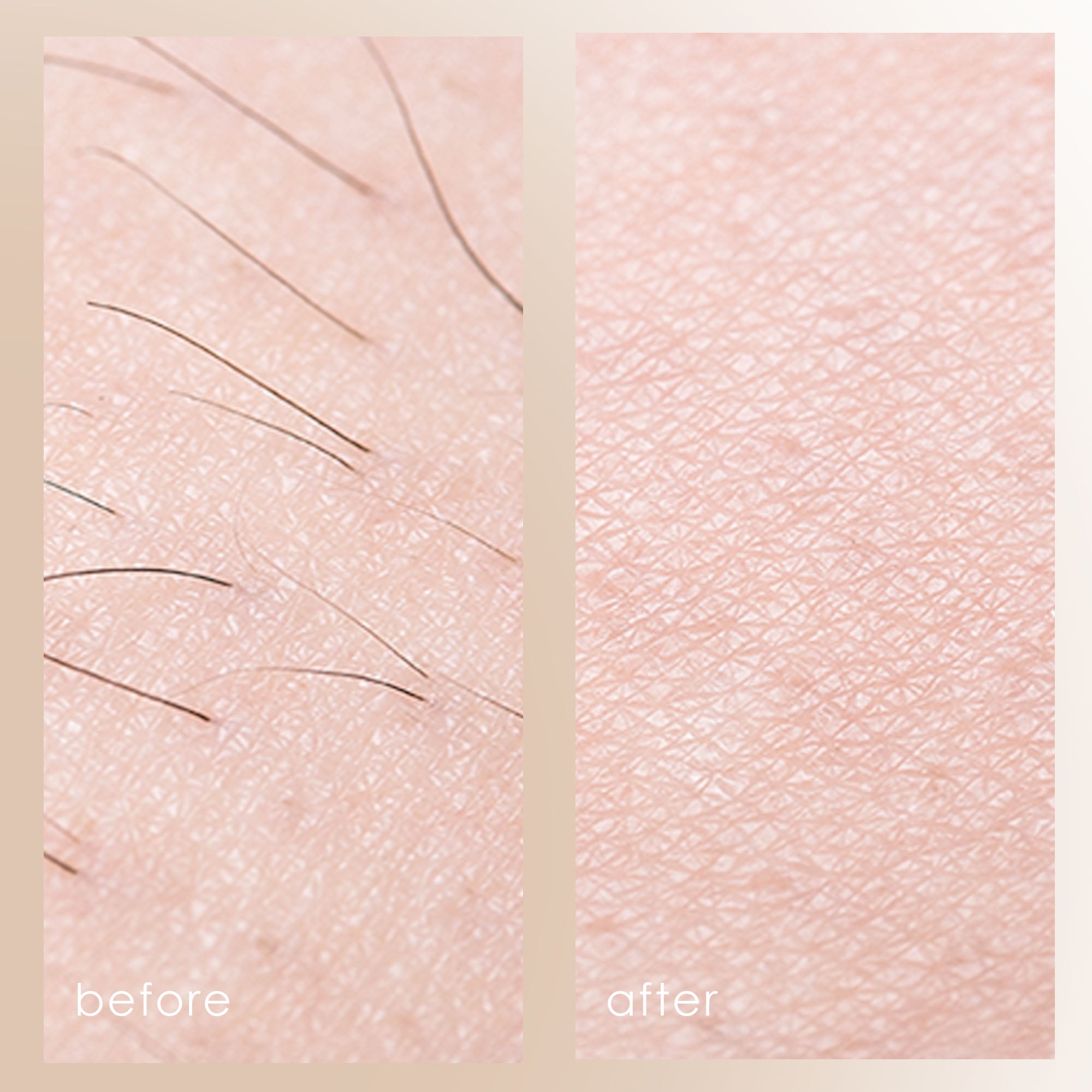 SmoothPro+ | IPL Hair Removal Device