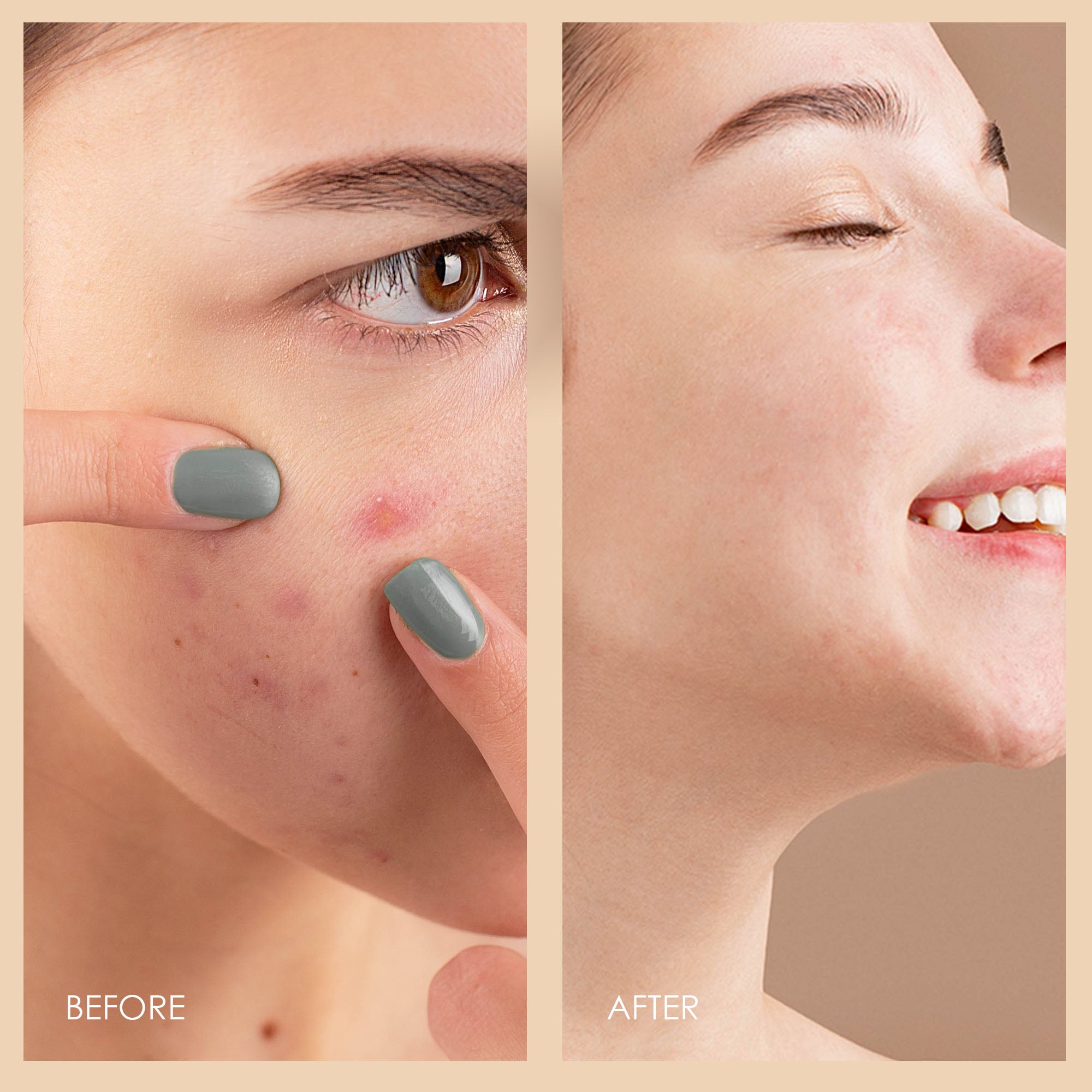 Blue LED+ | Acne Light Therapy