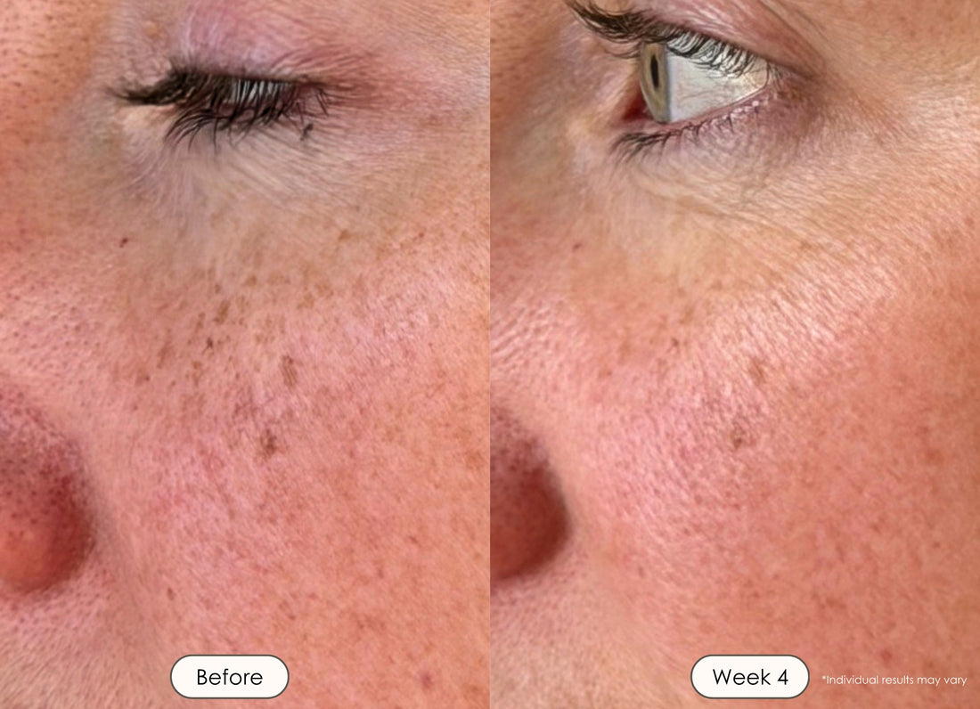 Close-up of under-eye and cheek skin showing improved tone after 4 weeks.