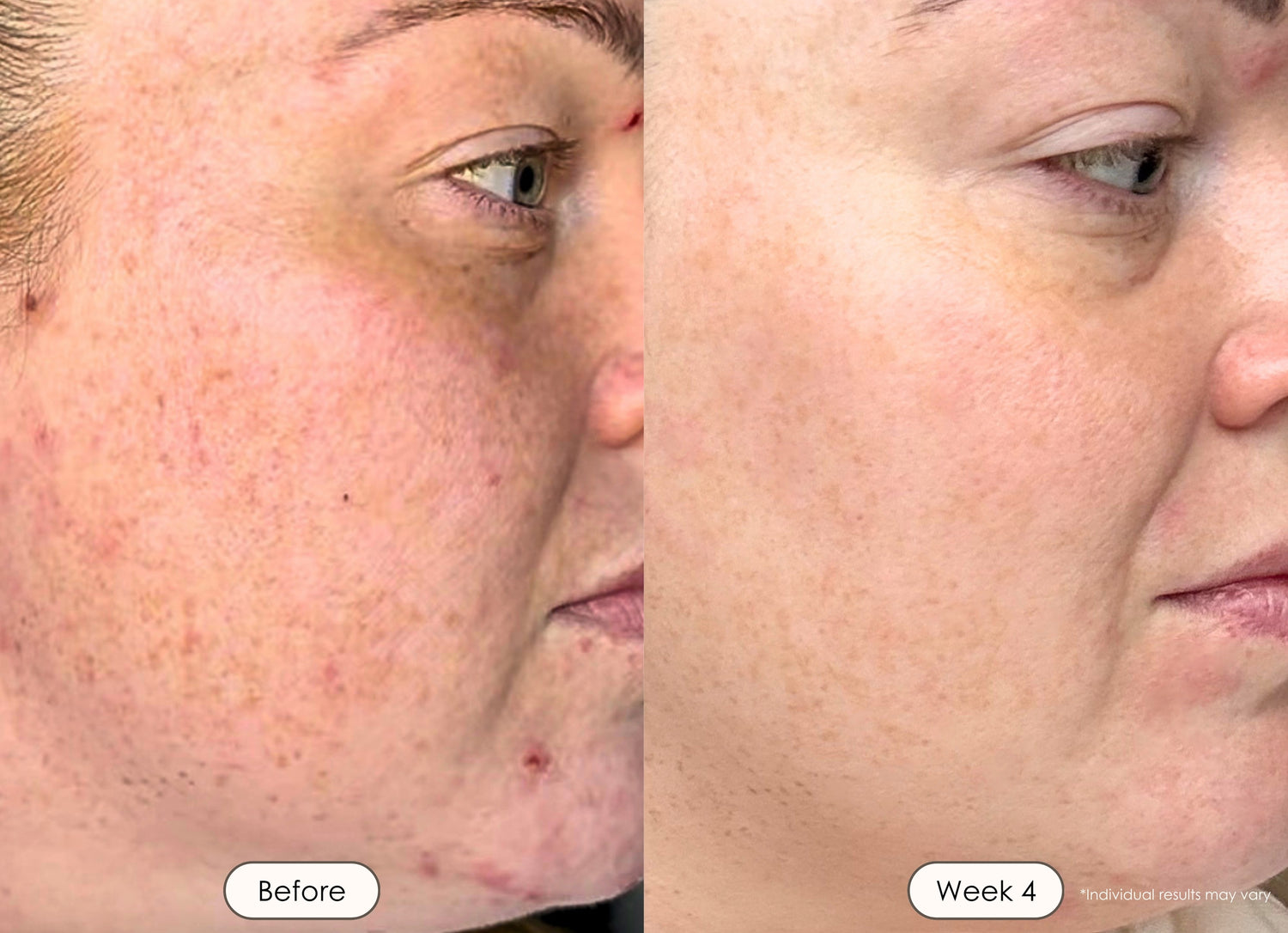 Skin transformation progress photo featuring enhanced glow and even-looking complexion after using LED light therapy.