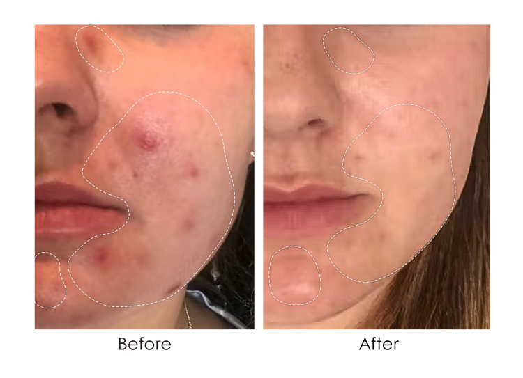 LightAura Plus | LED Face & Neck Mask