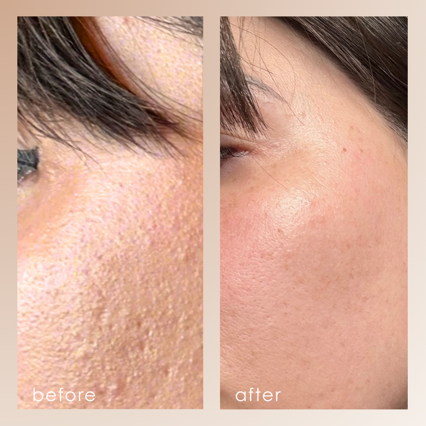 Reinvo | Facial Microdermabrasion Wand